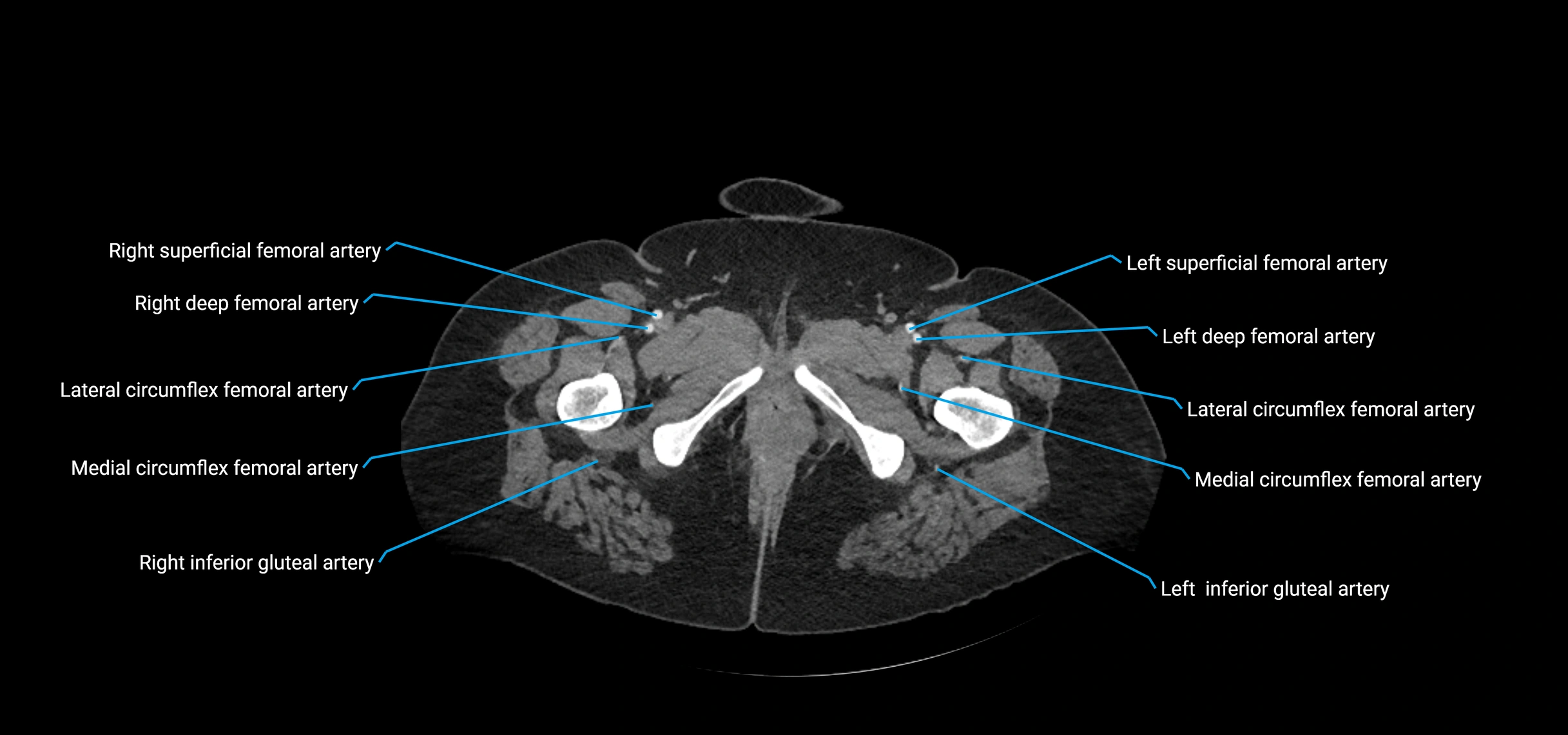 CTA abdomen axial cross sectional anatomy labelled image_277 (2).webp